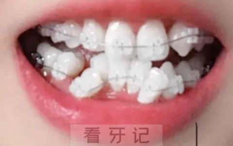 牙齿矫正什么年龄做效果最好20多岁矫正牙齿算不算晚