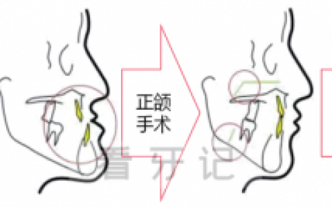武汉**口腔地包天看牙记