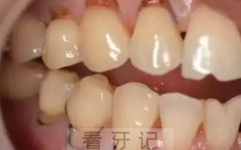 楔状缺损高清图片汇总
