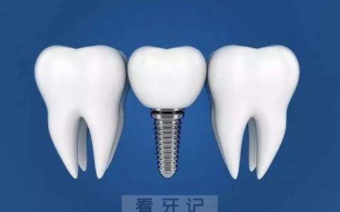 种植牙集采什么时候落地是不是停了