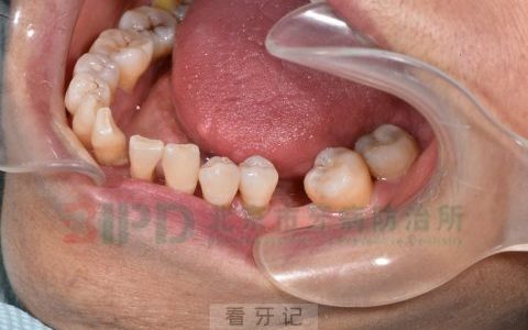 缺牙危害高清图片