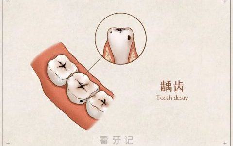 龋齿蛀牙牙齿龋坏程度等级分级