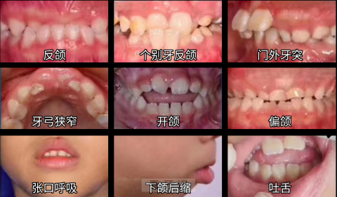需要牙齿矫正的牙齿类型分类