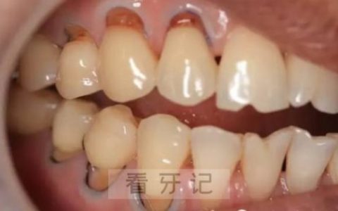 楔状缺损高清图片多图
