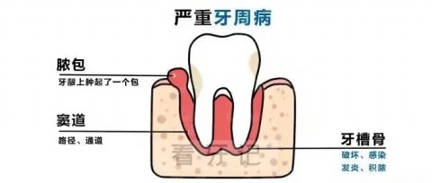 牙周炎七大症状