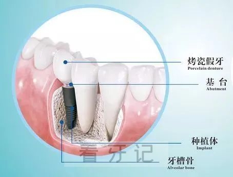 上海中博口腔医院种植牙六大优势科普