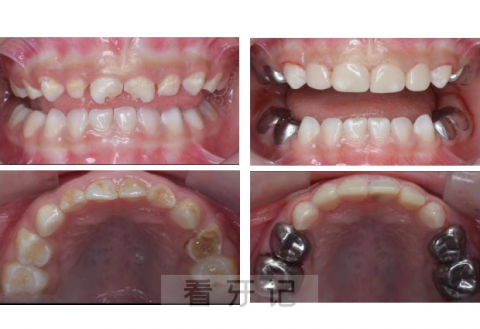 乳牙预成冠长什么样实际图片