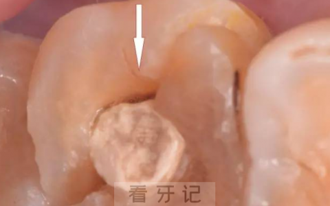 牙隐裂真实图片
