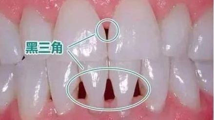 牙齿“黑三角”高清图片