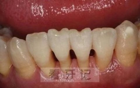 牙齿“黑三角”高清图片