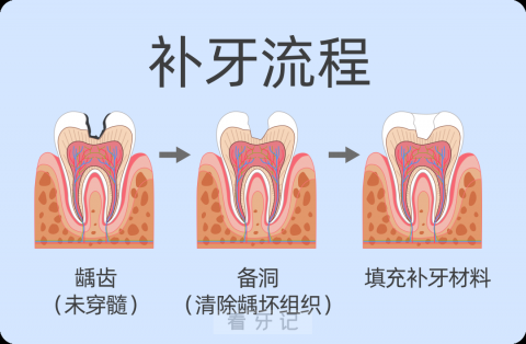 补牙流程图示