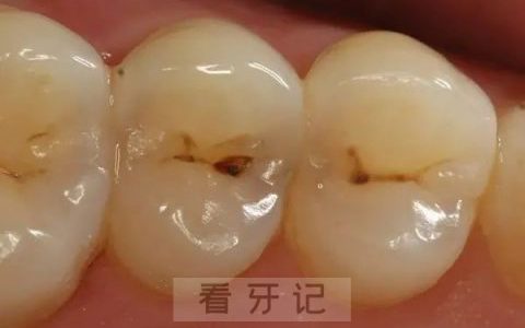 中龋图片