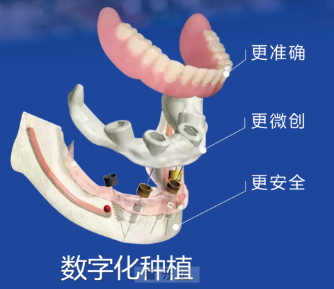 南京康贝佳口腔医院推出睡眠式舒适种植牙技术