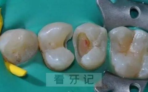儿童补牙橡皮障图片