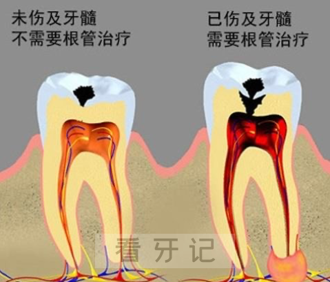 蛀牙三大阶段附龋齿图片