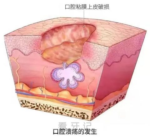 复发性口腔溃疡图片