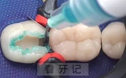 淘宝拼多多上的DIY补牙材料靠不靠谱