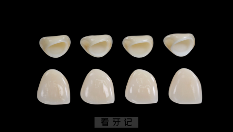 全瓷牙比金属烤瓷牙优点缺点对比整理