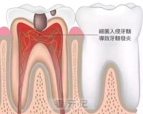 牙髓炎会不会自行好转