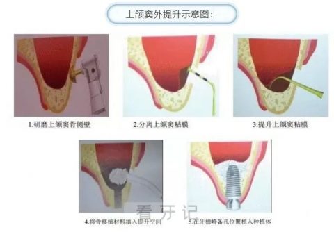 种牙前一定要做上颌窦提升术吗