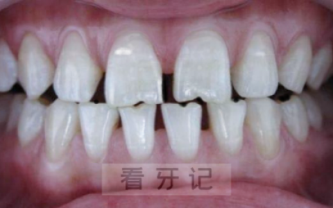 牙缝变大牙槽骨吸收真实图片