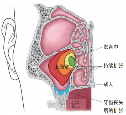 种牙前一定要做上颌窦提升术吗