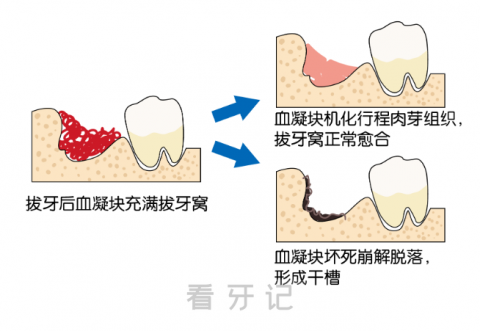 到底什么是干槽症