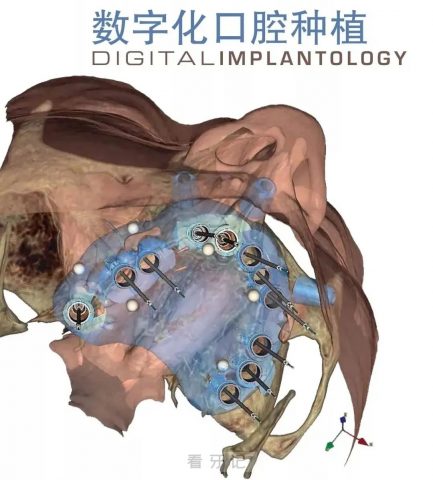 数字化种植牙四大优点