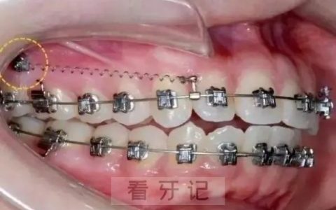 什么是骨钉附真实打骨钉照片
