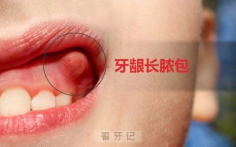 牙龈长脓包高清图片附建议千万别自行刺破戳破