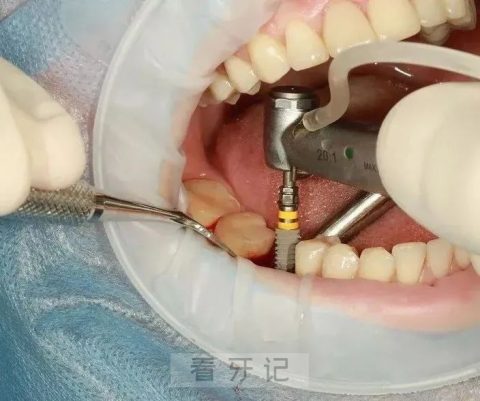 广东省口腔医院种植牙科普附种牙真实过程图片