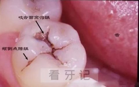 窝沟龋高清图片