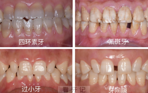 瓷贴面哪些人适合瓷贴面四大适应症附对比图片