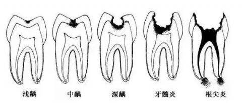 龋齿恶化发展五大过程