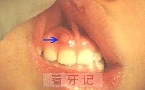 牙龈“鼓包”高清图片对比参考