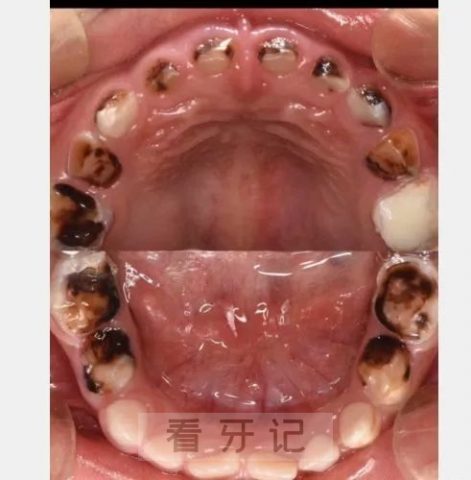 严重的儿童蛀牙长什么样附龋齿图片