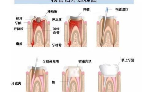 根管治疗过程疼不疼附过程图片
