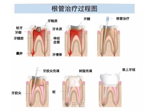 根管治疗过程疼不疼附过程图片