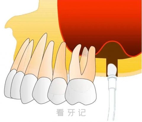 什么是上颌窦？种植牙为什么要做上颌窦提升术