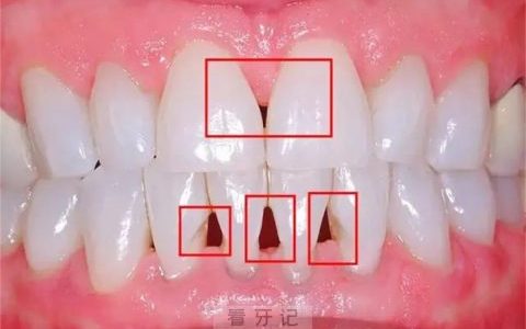 牙龈萎缩黑三角高清图片