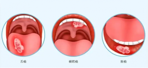 口腔癌四大病因附图片