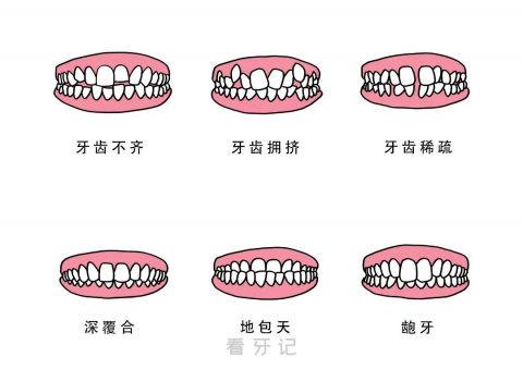 什么是错颌畸形附示意图片