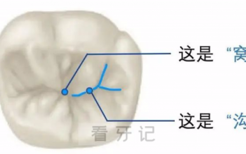 牙齿窝沟图片图解