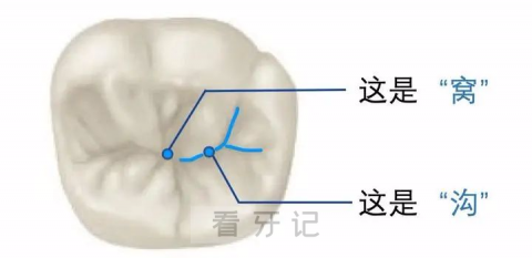 牙齿窝沟图片图解