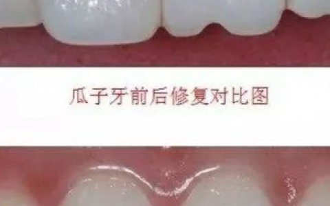 什么是“瓜子牙”附瓜子牙照片
