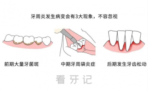牙周炎前期中期后期三大表现附图片