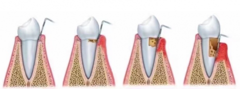 牙周炎前期中期后期三大表现附图片