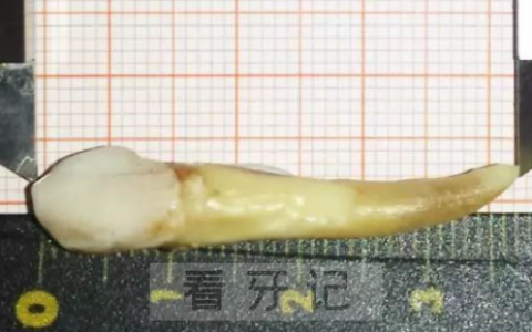 人类的牙齿正常有多长？最长有多长？