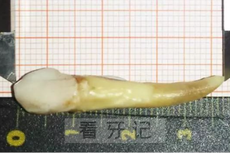 人类的牙齿正常有多长？最长有多长？