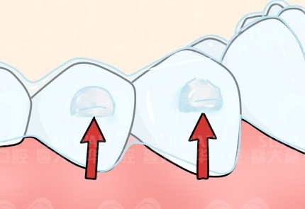 矫正牙齿时牙齿白色东西是什么